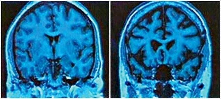 Слева — нормальный мозг 43-летнего человека, справа — мозг 43-летнего алкоголика 