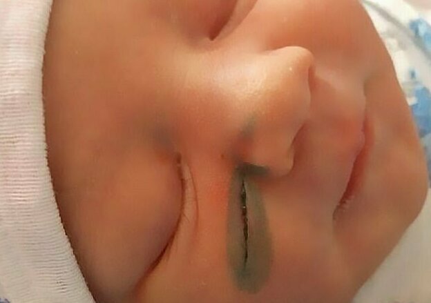 Хирурги порезали младенцу лицо во время кесарева сечения