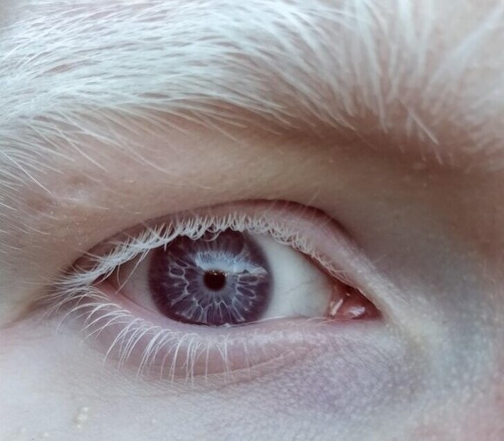Глаза фиолетового цвета