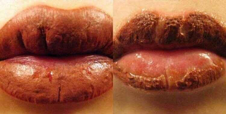 Причины осложнений после татуажа губ