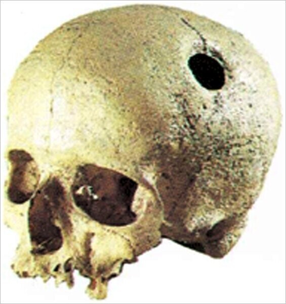 Инки – специалисты по трепанации черепа