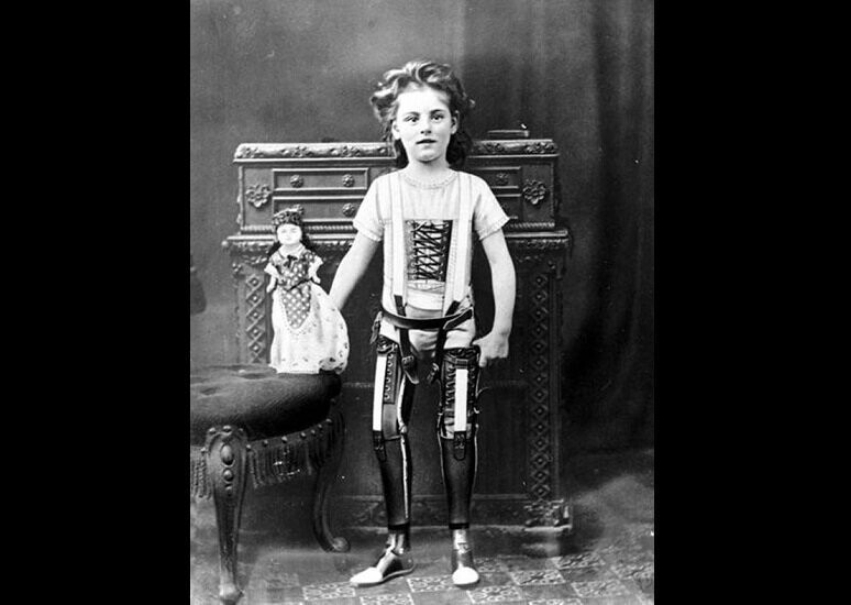 Маленькая девочка в 1890 году использует вспомогательное устройство для ходьбы.