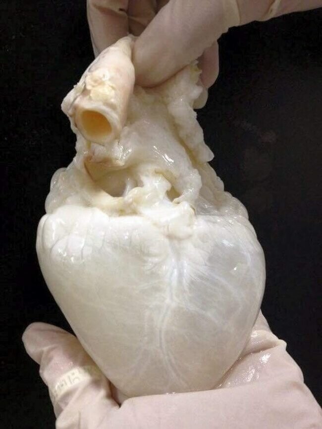 Это трансплантация сердца.