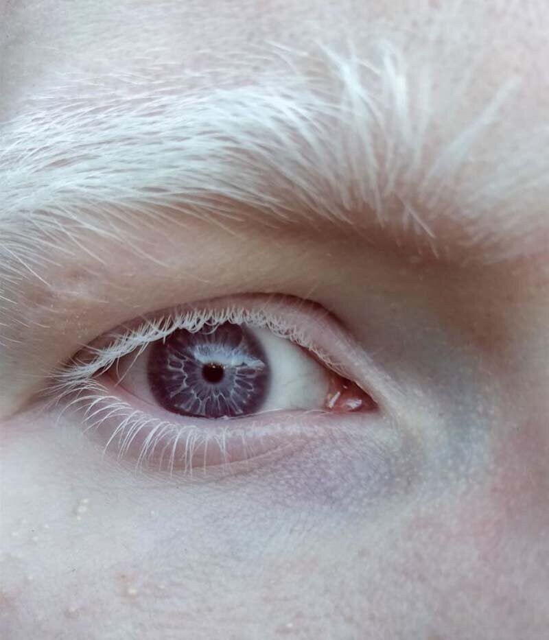 А вот так выглядят глаза настоящего альбиноса - человека, у которо совсем отсутствуют обычные для других пигменты