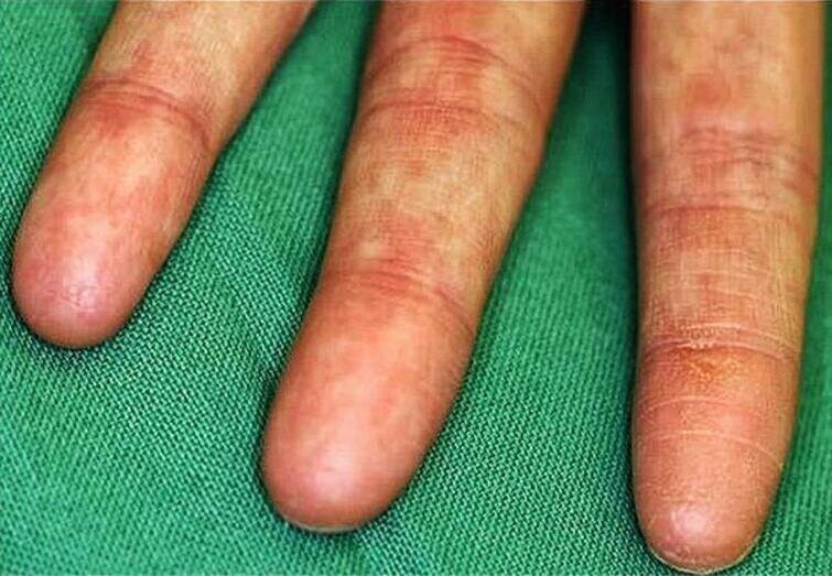 Адерматоглифия — чрезвычайно редкое генетическое заболевание, при котором у человека нет отпечатков пальцев