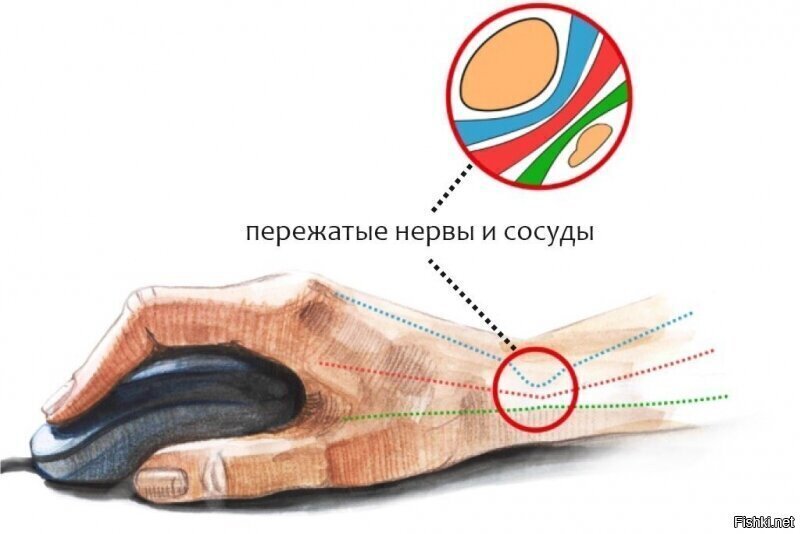 А помните,в конце 90-х были страшилки про "туннельный синдром"