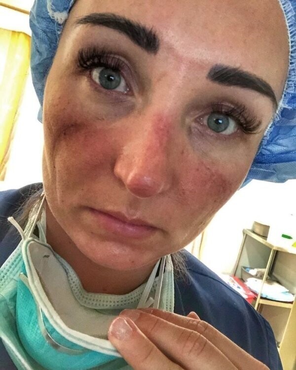 Пронзительные фото ран на лицах красавиц-медсестер, которые просят вас оставаться дома