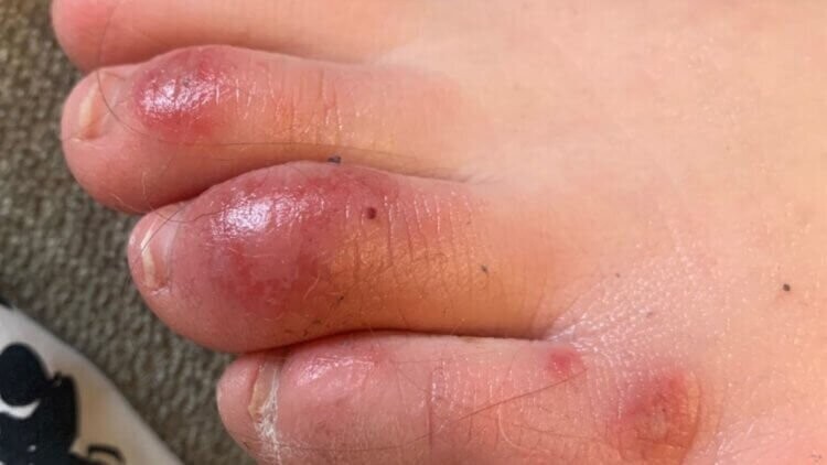 Коронавирус: осложнения Коронавирусные пальцы