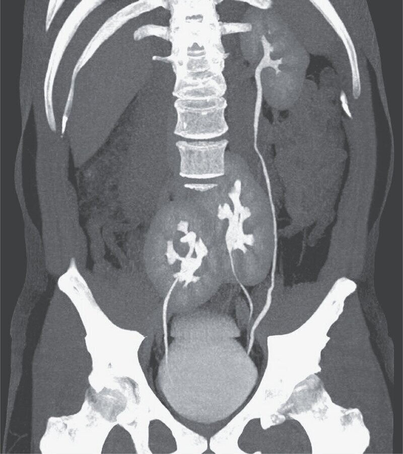 Медики опубликовали снимок компьютерной томограммы мужчины с тремя почками