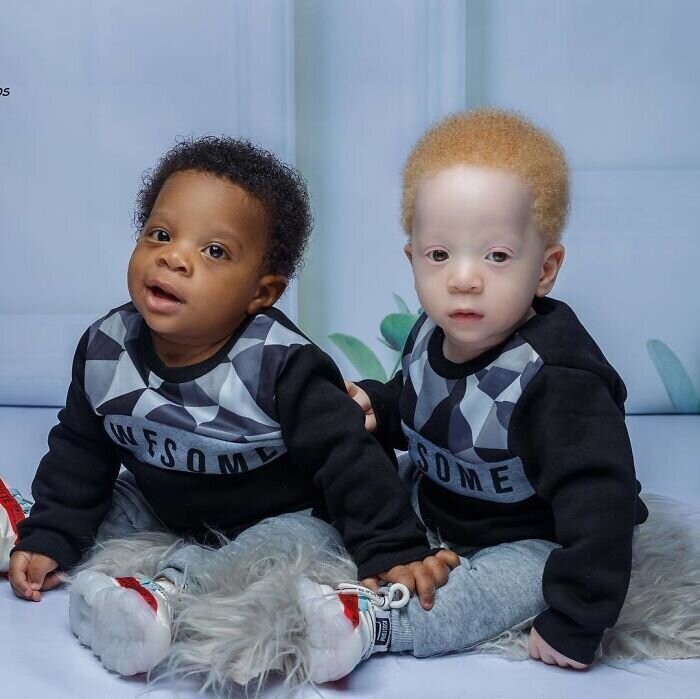 В Нигерии родились близнецы с разным цветом кожи