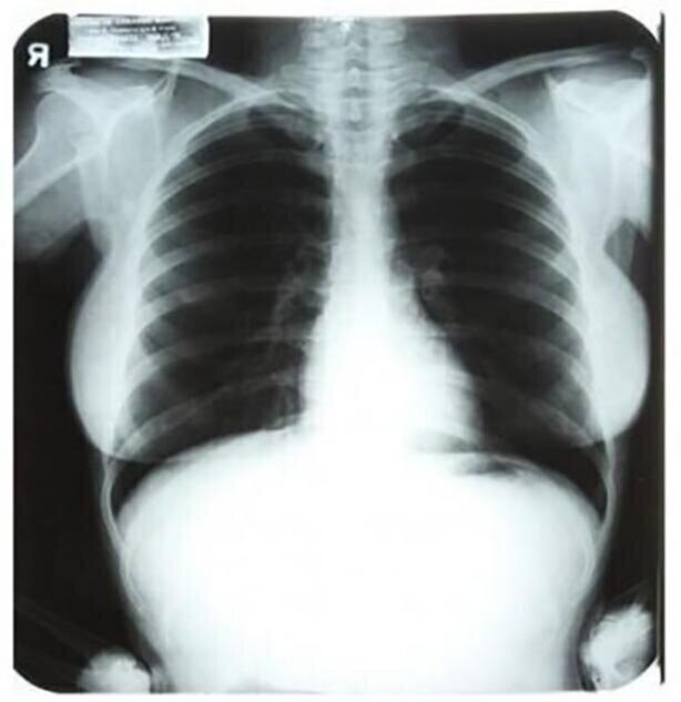 Самые дорогие рентгеновские снимки — $45 000 за три штуки