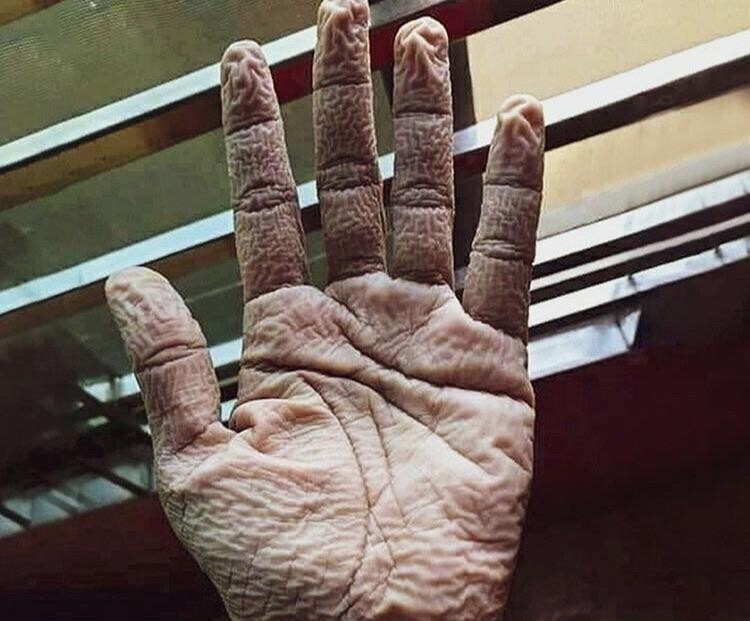 Врач из Индии показал, как выглядит его рука после 10-часового ношения перчаток