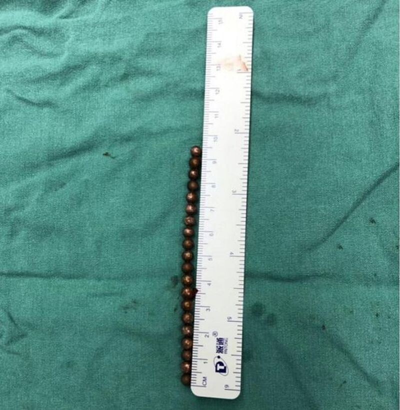 В Китае врачи вытащили из пениса мальчика 20 магнитных шариков