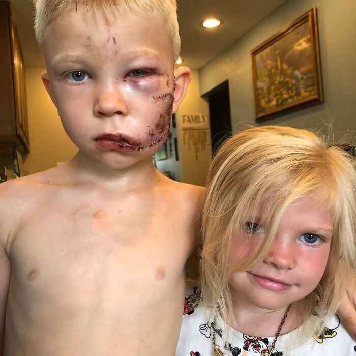 6-летний Бриджер защитил свою 4-летнюю сестру от агрессивной собаки, которая на них напала.  Он встал между собакой и своей сестрой, чтобы её спасти