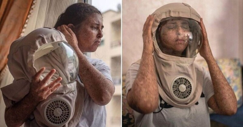 Женщина с аллергией на солнце не выходит на улицу без маски уже двадцать лет