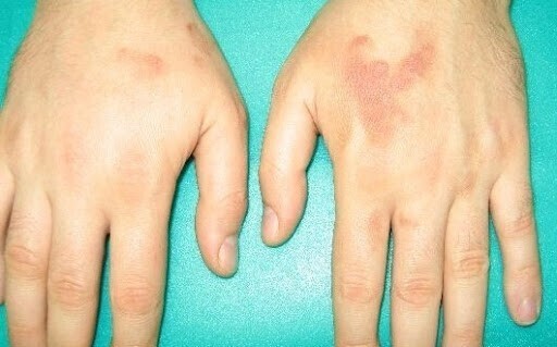 Аллергия и кожные проявления