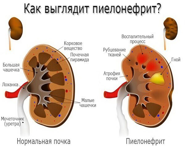 Пиелонефрит – симптомы, причины, виды и лечение пиелонефрита