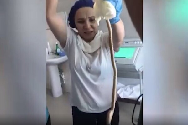 Видео из операционной: изо рта россиянки медики извлекли огромную змею