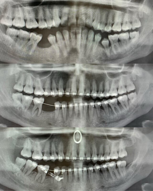 14. «Мои зубы до брекетов и после»