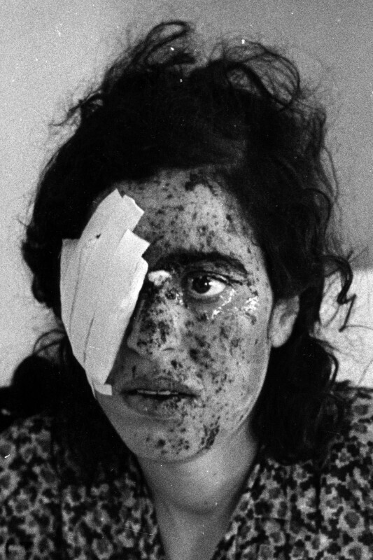 Сентябрь 1970 года. Иордания. Госпиталь в Аммане. Жертва городских боев.