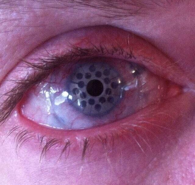 6. Глаз после кератопротезирования — замены роговицы человека на искусственную