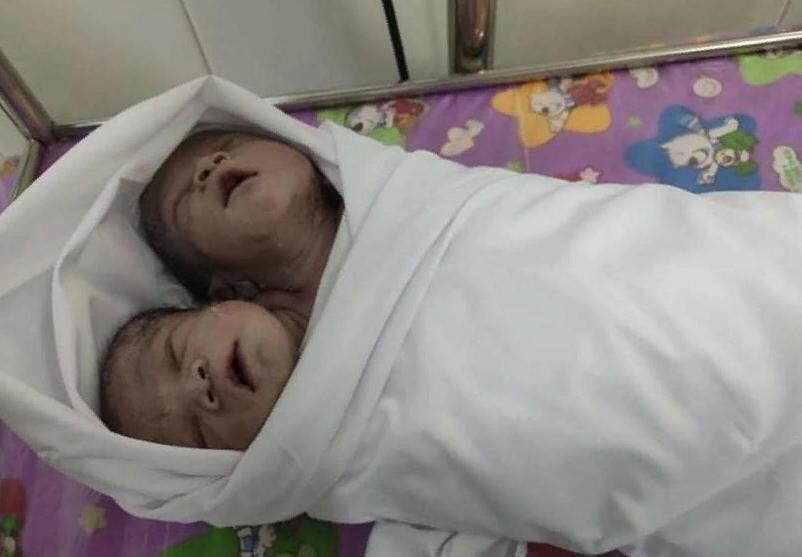 В Азии родился здоровый двуглавый малыш