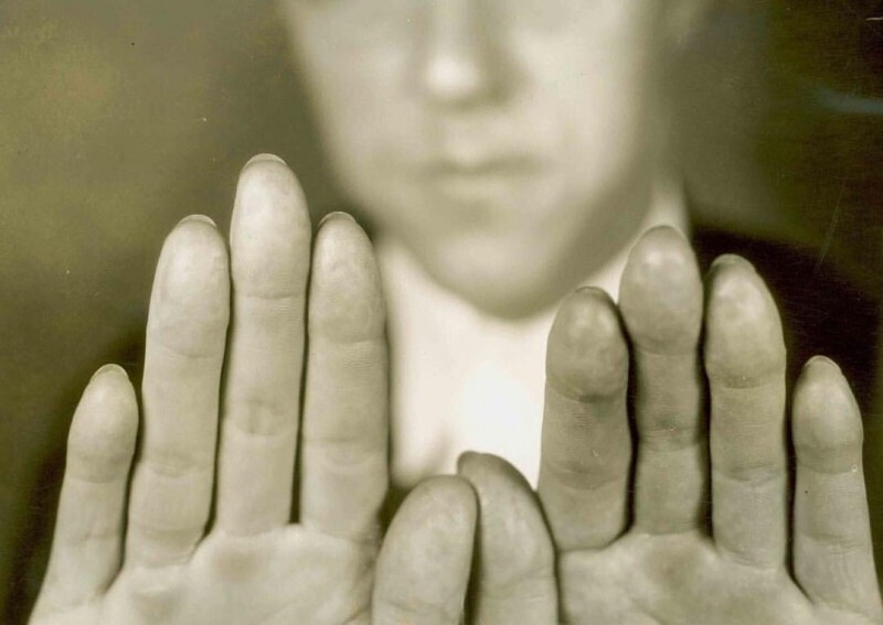 Гангстер Элвин Карпис демонстрирует руки с удаленными отпечатками пальцев. США, 1936
