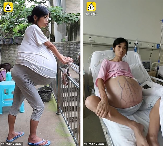 Из-за рака яичников у китаянки вырос 40-килограммовый живот