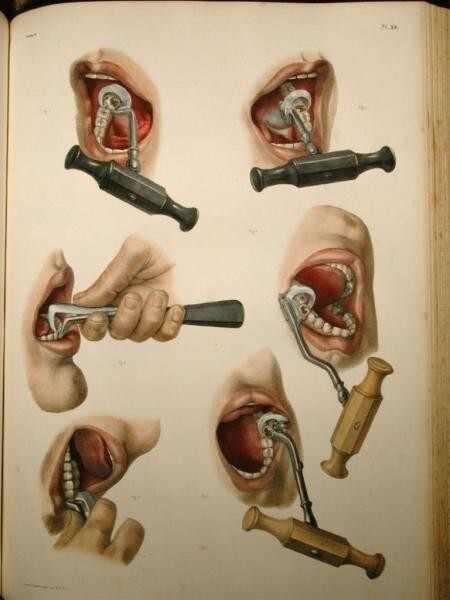 Удаление зубов с помощью зубного ключа в Traité Complete d'anatomie de l'homme , 2-е изд. (1866–1871), JM Bourgery