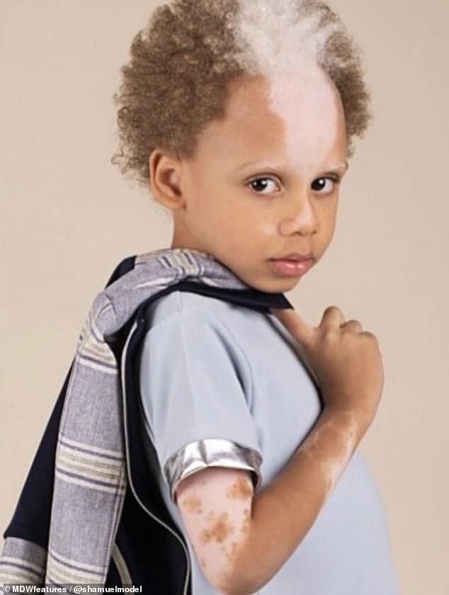 Мальчик с редким заболеванием кожи подписал контракт с модельным агентством