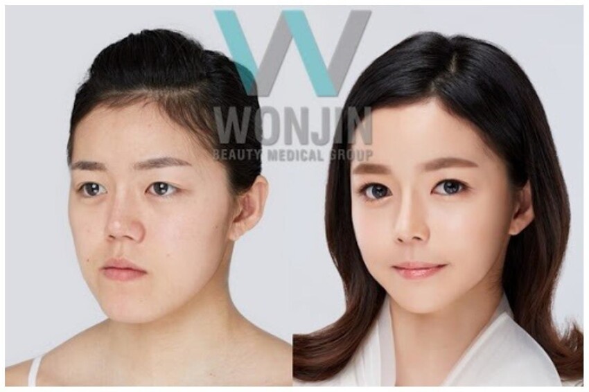 Одна из обязательных операций - избавление от так называемых "корейских" глаз - южнокорейские родители дарят своим дочерям-подросткам деньги на операцию, которая называется "двойная хирургия глаз"