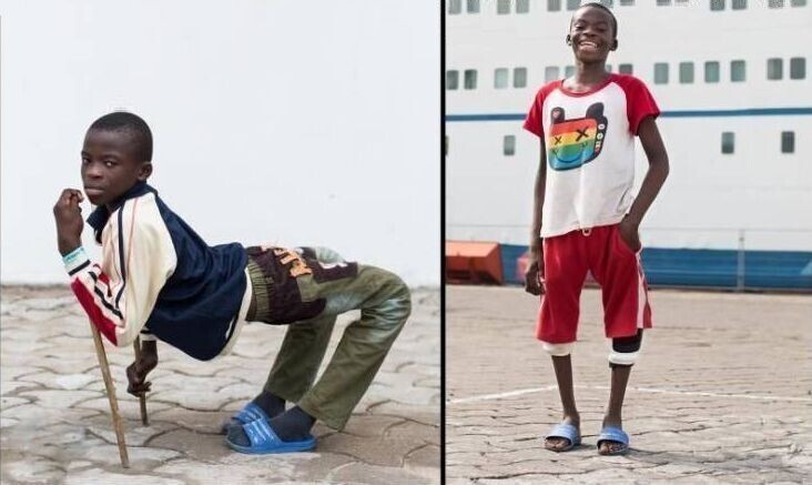 Мальчик по имени Ульрих до и после операции по исправлению ног