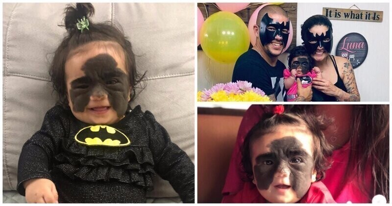 Год назад маленькая американка с родимым пятном в виде «маски Бэтмена» поехала лечиться в Россию