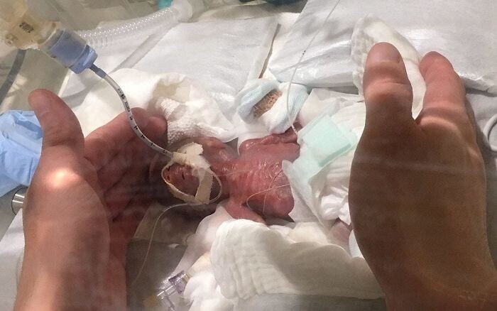 Мальчик, родившийся с весом 268 граммов и выхоженный врачами токийского госпиталя. Он считается самым маленьким выжившим недоношенным ребенком в истории