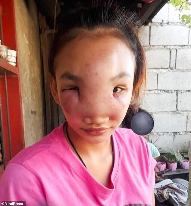 Молодая филиппинка, выдавив прыщ, осталась без лица