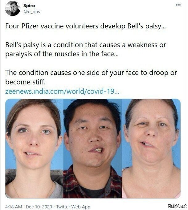 Четверо добровольцев после вакцины Пфайзер бонусом получили паралич Белла