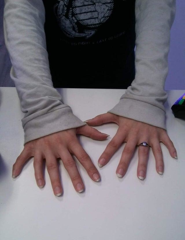 У этой женщины по шесть пальцев на каждой руке