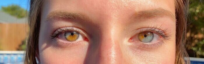 2. Частичная гетерохромия обоих глаз