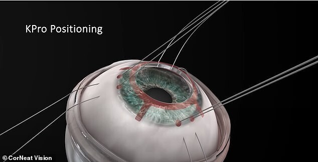 В Израиле впервые сделали операцию по пересадке искусственной роговицы глаза