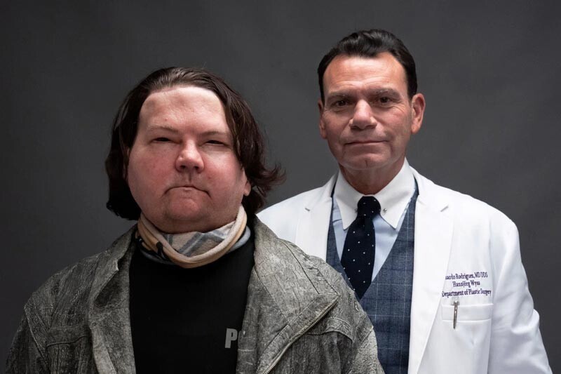 Мужчине, пострадавшему в автокатастрофе, впервые в мире была сделана трансплантация лица
