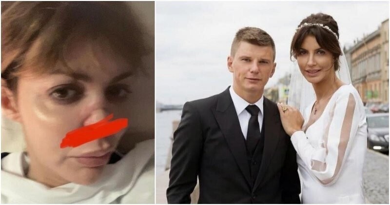 Экс-супруга Аршавина впервые показала, что стало с ее носом (5 фото)