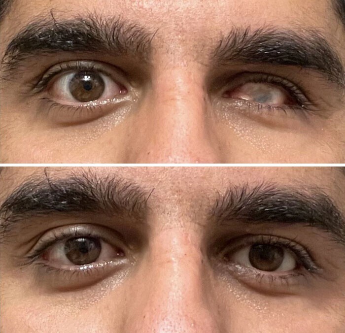 30. "Фотографии до и после того, как я вставляю свой искусственный глаз"