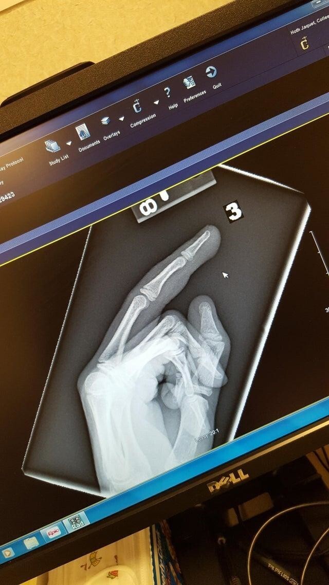 Моя дочь прищемила дверью палец на руке. Перелом не выявили, но рентген получился оскорбительным