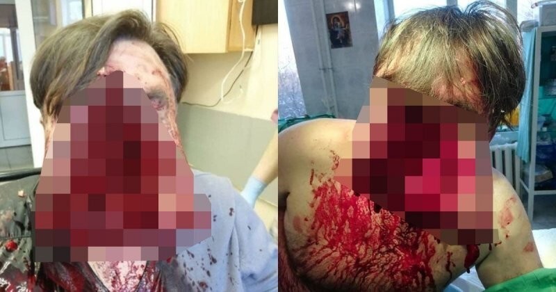 Неудачная попытка самоубийства в Подмосковье: врачи сшили лицо мужчине