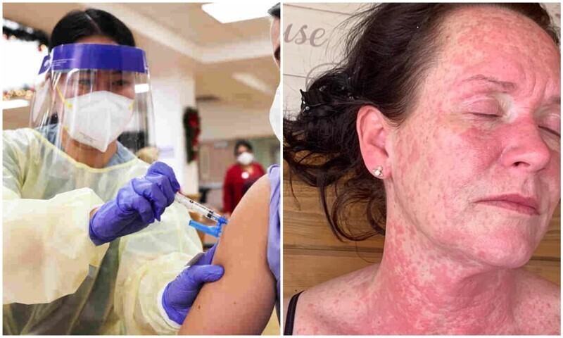 У женщины появилась жуткая сыпь после вакцины AstraZeneca