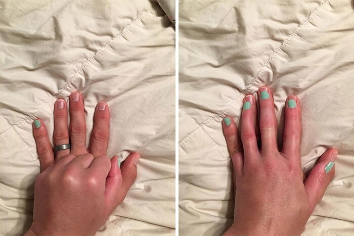 6. Потерявшая палец девушка красила ногти, и муж предложил побыть ее "суррогатным мизинцем"