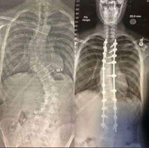13. Рентгеновский снимок спины до и после операции по выравниванию позвоночника из-за сколиоза