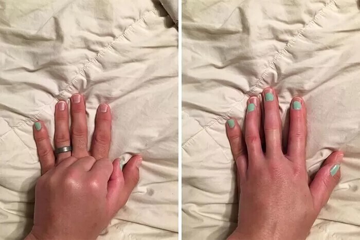 Потерявшая палец девушка красила ногти, и муж предложил побыть ее «суррогатным мизинцем»