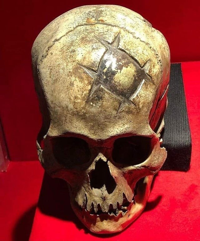 На этом черепе инков была выполнена трепанация, и в качестве имплантата использовали золотую пластину, которая показывает четкую реконструкцию кости