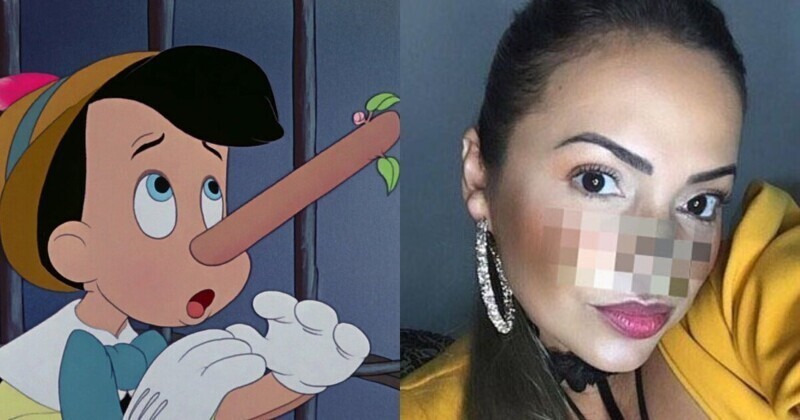 Из-за врожденной болезни у бразильянки вырос нос, и ее дразнят Пиноккио